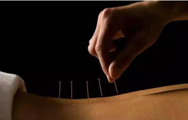 平衡針灸最新視頻，現(xiàn)代應(yīng)用探索針灸藝術(shù)的新境界