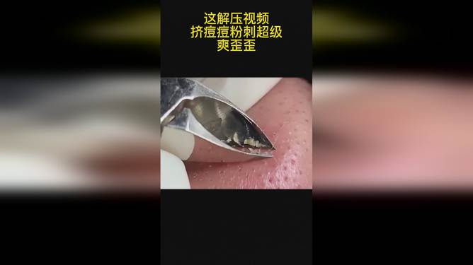 最新擠膿包視頻，見證變化的力量，自信與成就感的誕生之地